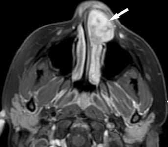 Minnie_Sinus_MRI