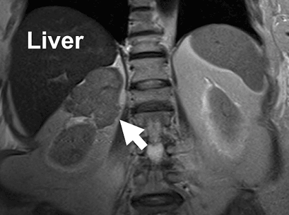 bella_MRI_Liver